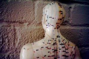 Acupuncture for PTSD